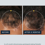 Nutrafol Men clinical study before and after 6 months