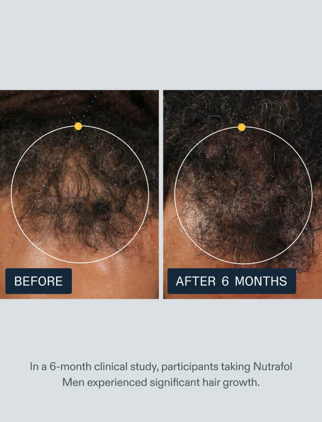 Nutrafol Men clinical study before and after 6 months