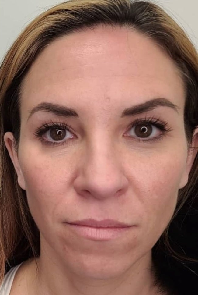 microneedling after treatment