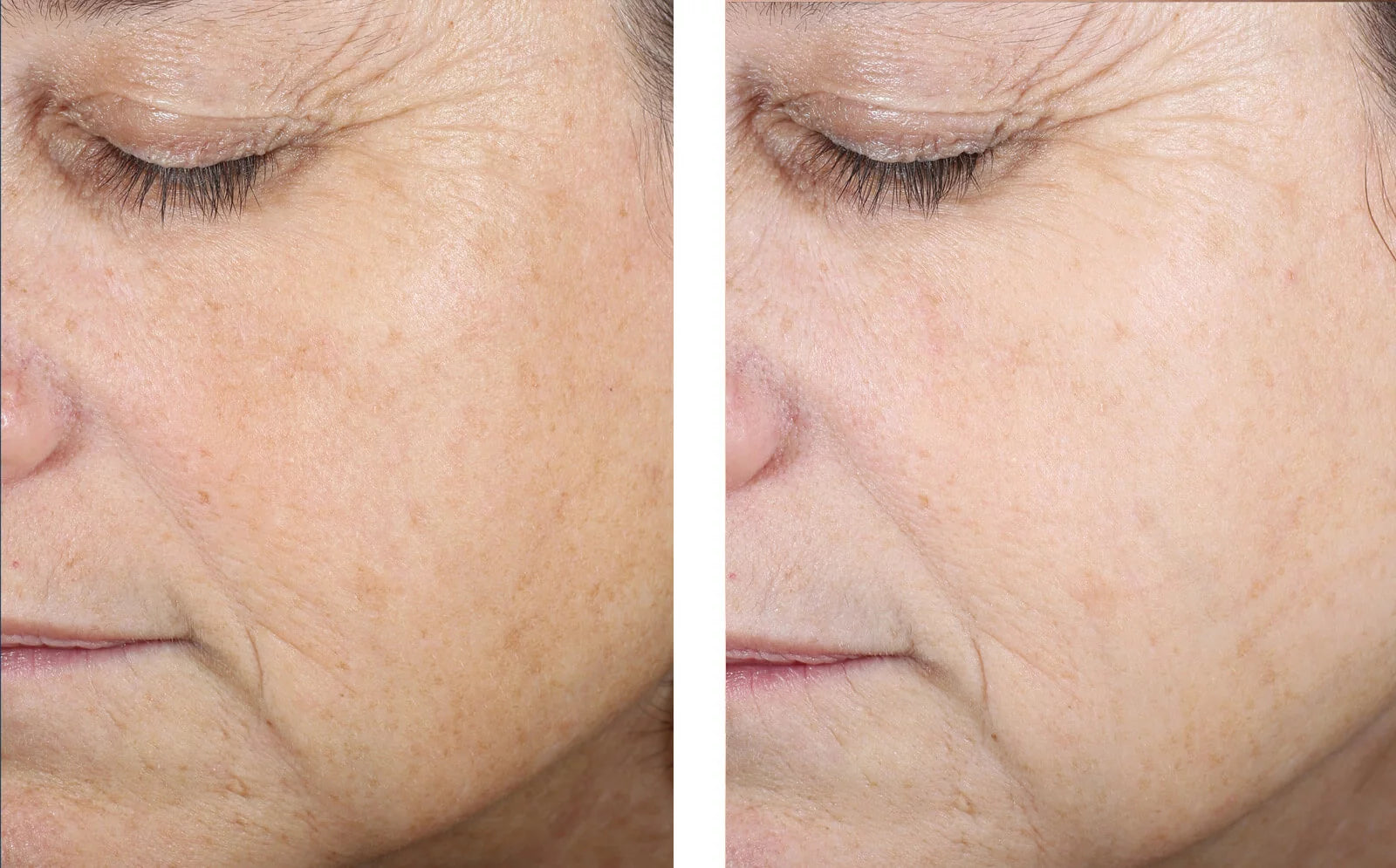 skinbetter science Even Tone Correcting Serum, results photo