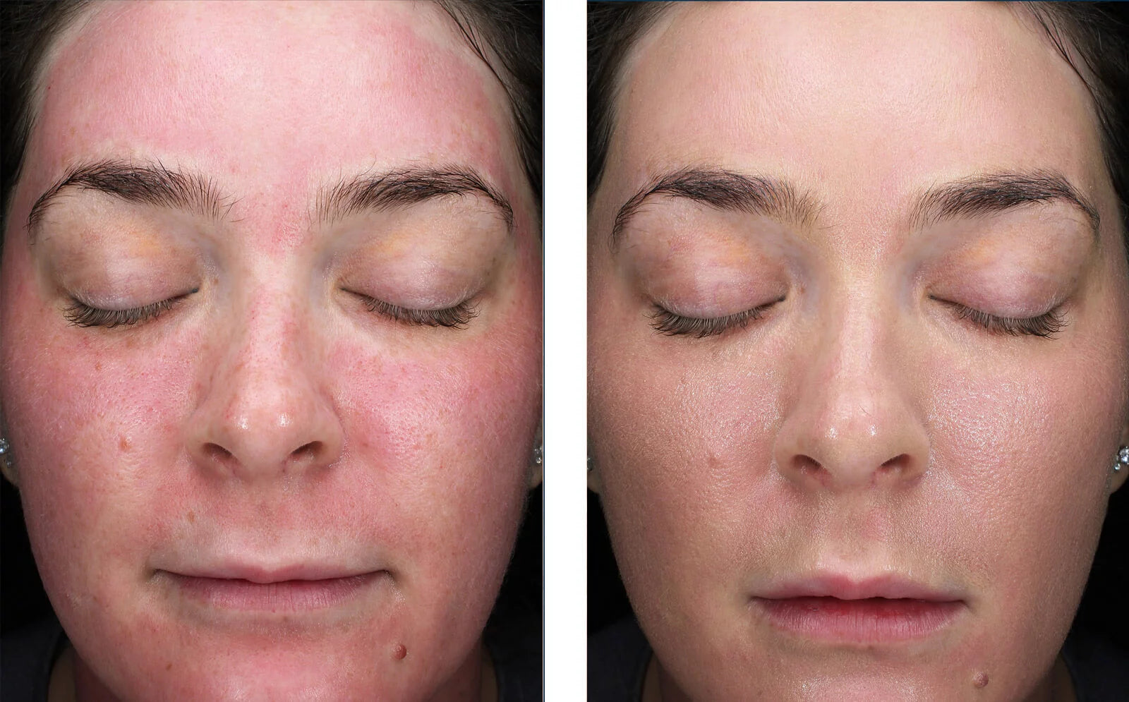 skinbetter science Sunbetter Tone Smart SPF 75 Lotion, results photo