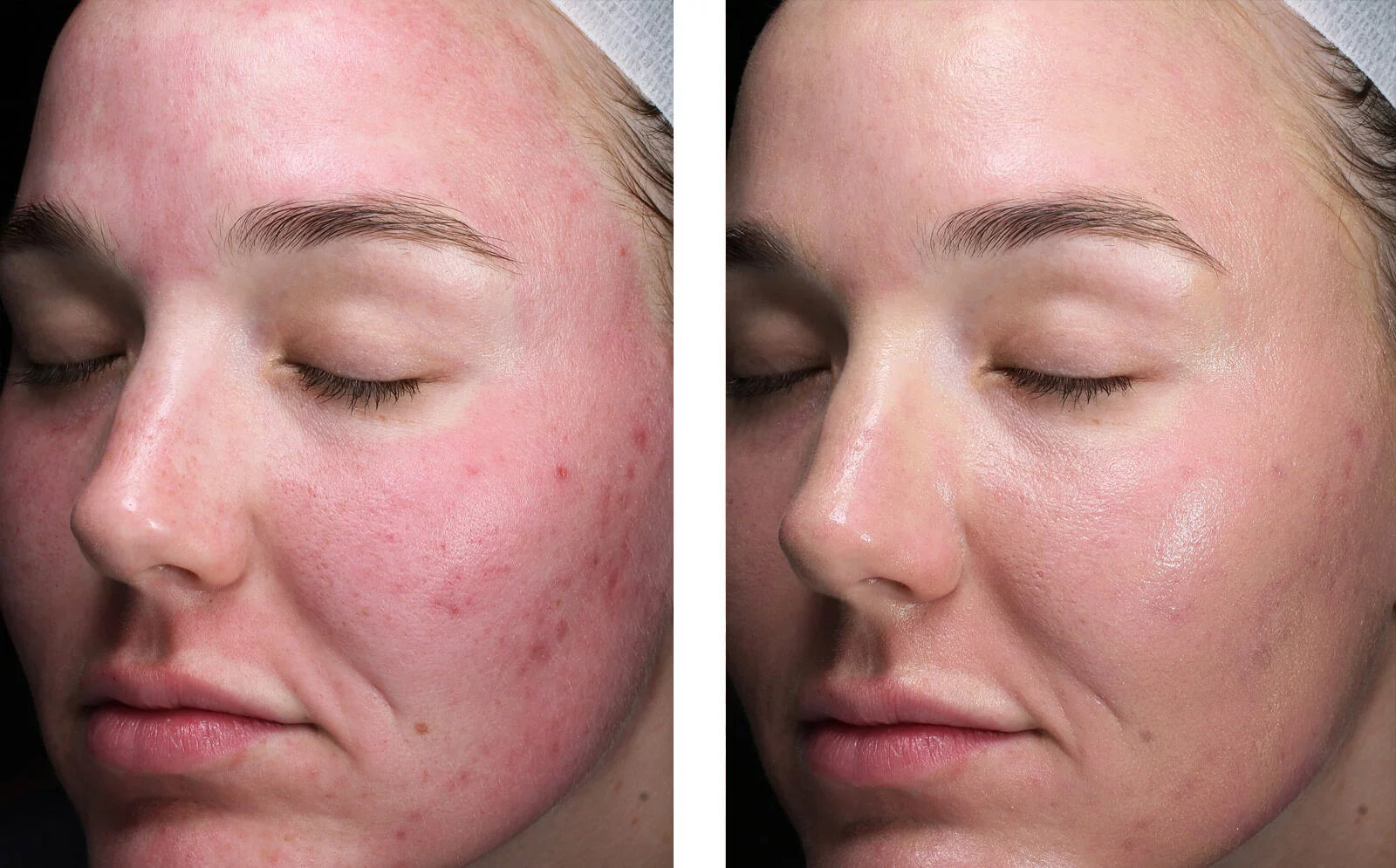 skinbetter science Sunbetter Tone Smart SPF 75 Lotion, results photo