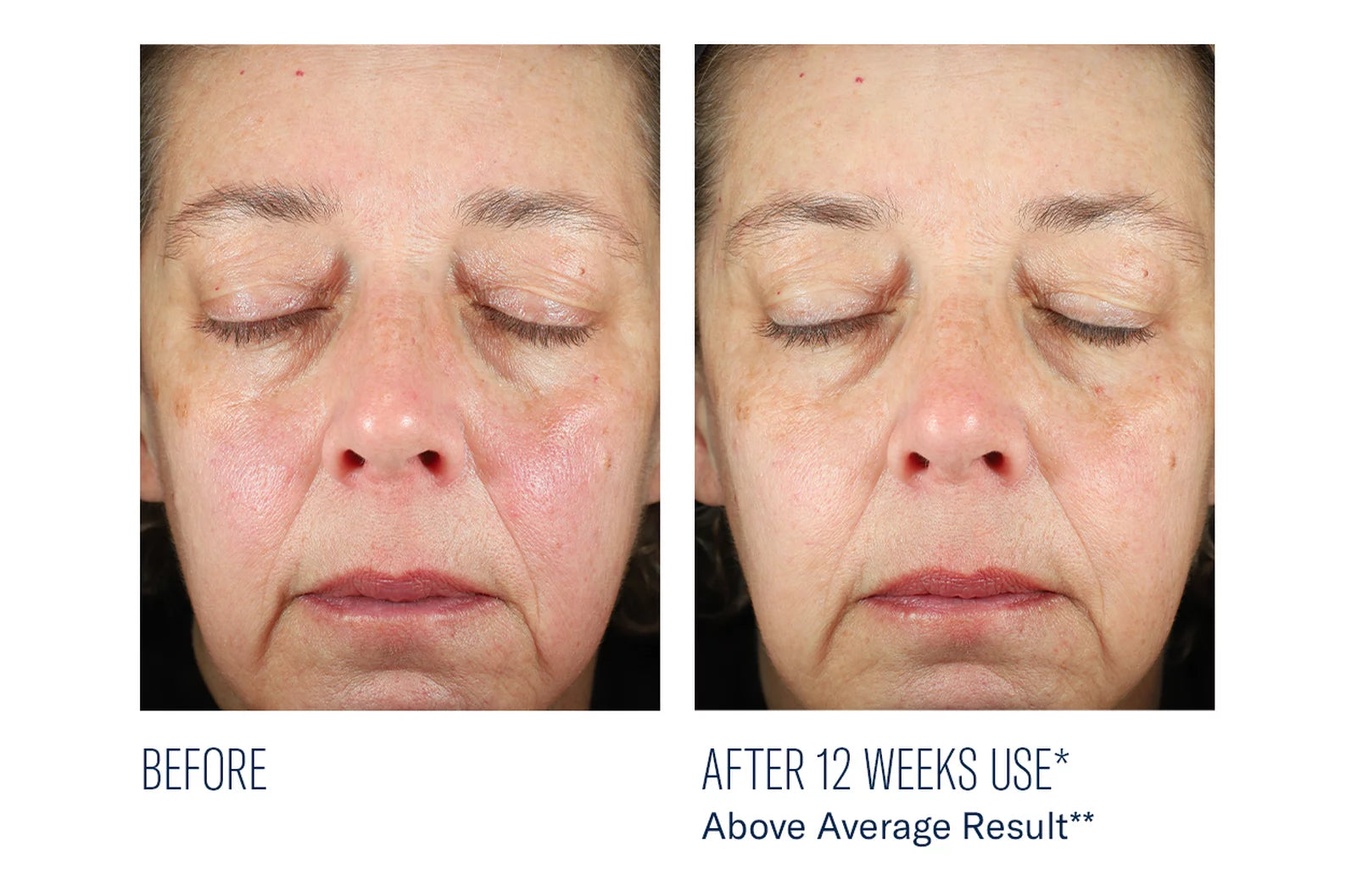 skinbetter science BioRewind Skin Health Dietary Supplement, before and after results