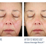 skinbetter science BioRewind Skin Health Dietary Supplement, before and after results