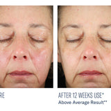 skinbetter science BioRewind Skin Health Dietary Supplement, before and after results