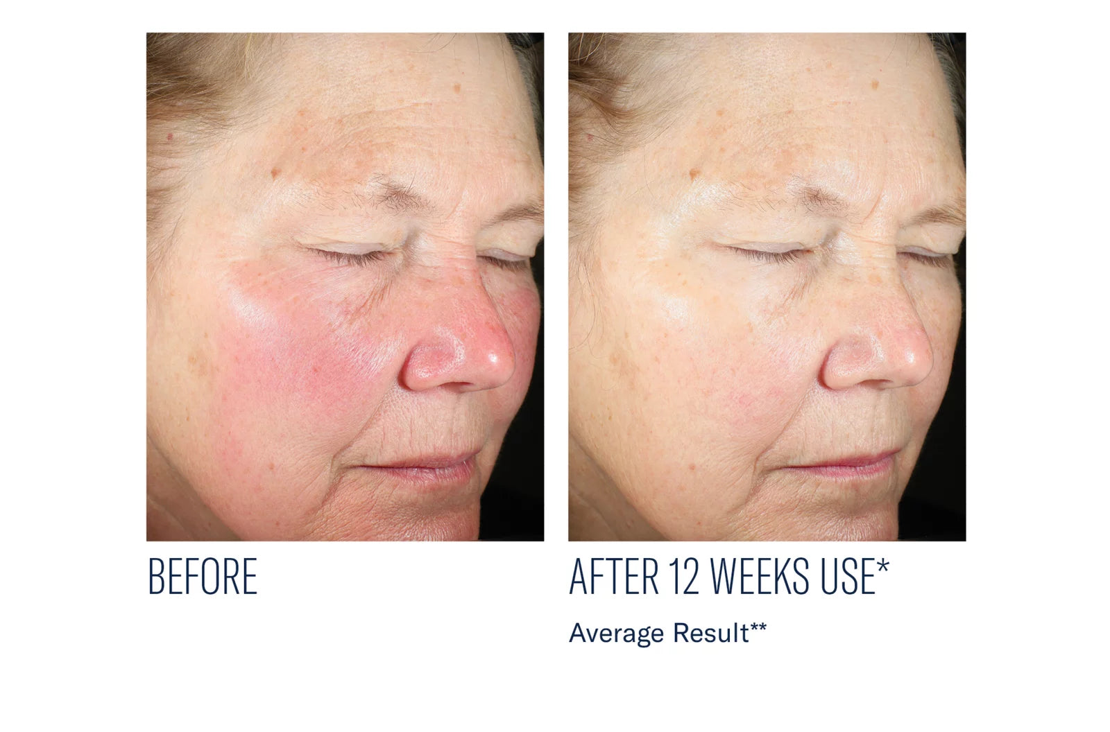 skinbetter science Even Intensive Skin Tone Correcting Serum, before and after results