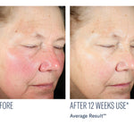 skinbetter science Even Intensive Skin Tone Correcting Serum, before and after results