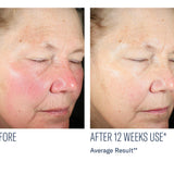 skinbetter science Even Intensive Skin Tone Correcting Serum, before and after results